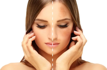 How to Reduce Hyperpigmentation Spots