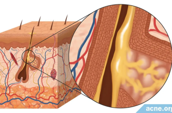 How To Reduce Sebum Production Internally