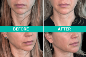 How to Care for Your Skin Before and After Ultherapy: Tips for Optimal Results