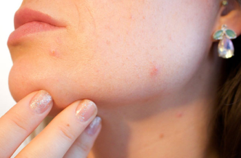 Dermatologists Explain Causes and Treatments for Ear Acne
