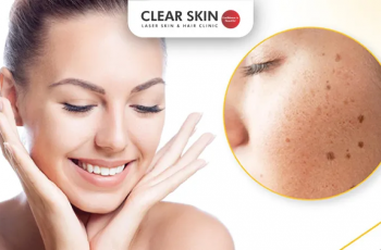 Expert Skincare Routine for Treating and Controlling Facial Melasma Naturally