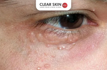 Natural Skincare Guide to Remove Milia and Smooth Your Skin