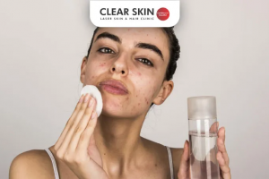 Effective Home Remedies and Skincare Tips for Clear, Acne-Free Skin